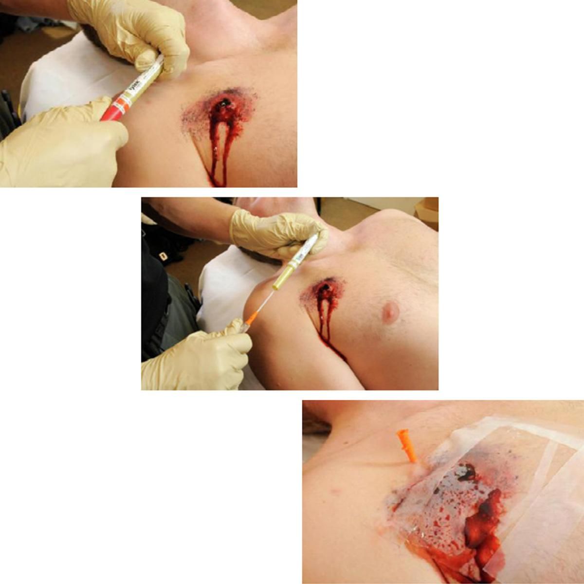 TPAK dekompresjonsnål 14 GA3,25 Sterile